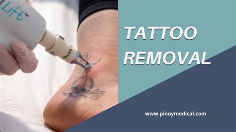 tattoo removal price philippines